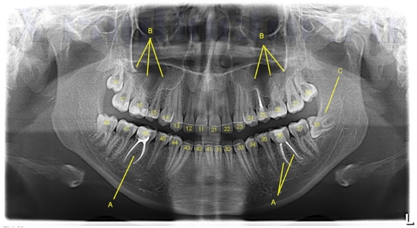зубной ряд и состояние нижней челюсти